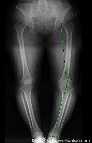 膝关节疼痛伴内翻畸形+骨性关节炎+半月板损伤 经典案例