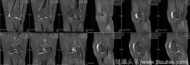 膝关节疼痛伴内翻畸形+骨性关节炎+半月板损伤 经典案例