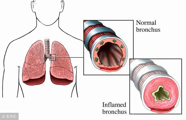 支气管哮喘家庭的救治方法与食疗方法