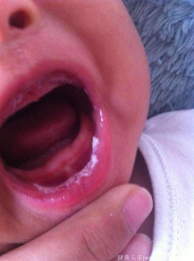 宝宝嘴里总有“奶块儿”，原来是这种病！