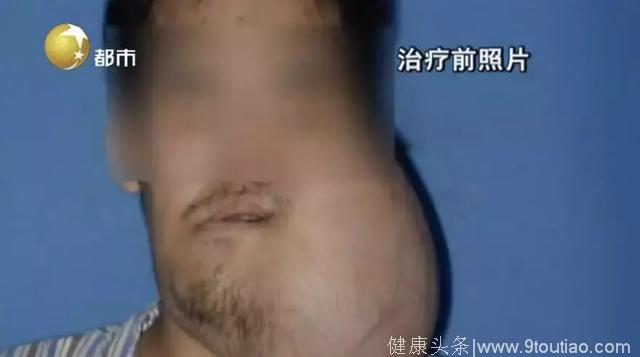 25岁小伙下巴长了个“排球”大的肿瘤，足足3.6斤！