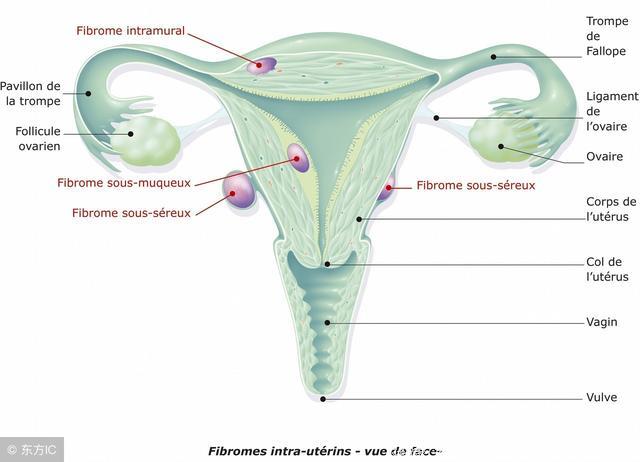 子宫肌瘤 生活方式暗藏陷阱