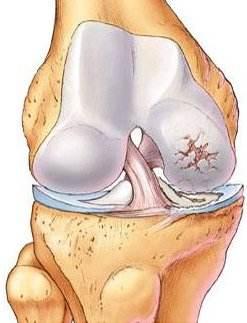 膝关节疼痛用氨基葡萄糖，为什么有人效果好，有人效果不好
