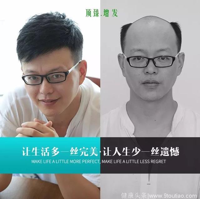 男性脱发，你该怎么办？（连载1）