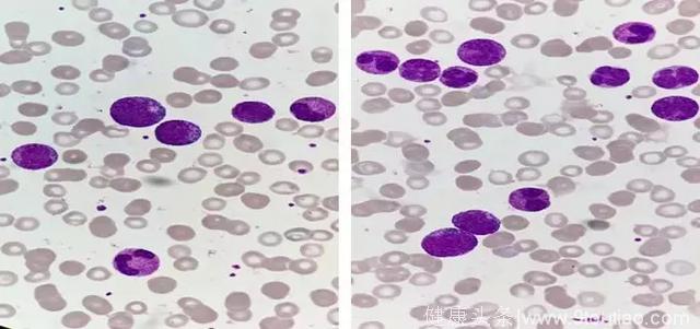 白细胞异常增高，考虑白血病吗？