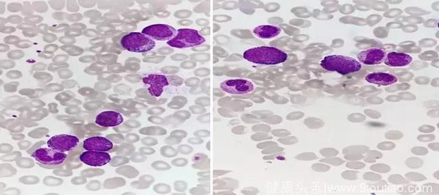 白细胞异常增高，考虑白血病吗？