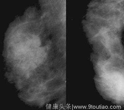 乳腺B超：BI-RADS 3级——是什么意思？严重吗？