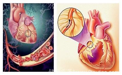 怎样知道是不是得了冠心病？