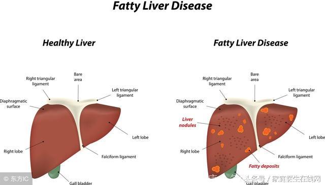 检查出脂肪肝不用慌，记准这4点，肝脏很快恢复如初
