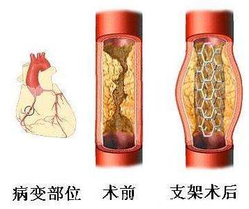 揭秘：冠心病支架的发展史与手术全过程