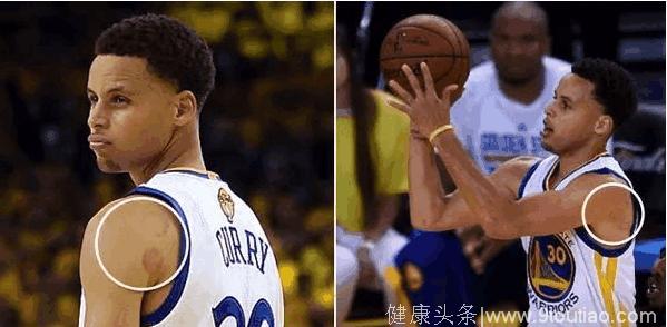 Nba库里通过拔火罐缓解伤痛！在nba这已经成为常态！