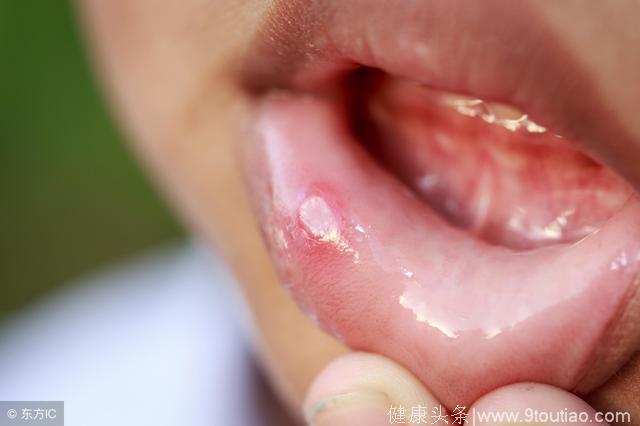 口腔科医生：口腔溃疡复发不断根，怀疑白塞氏病，一种茶水能治