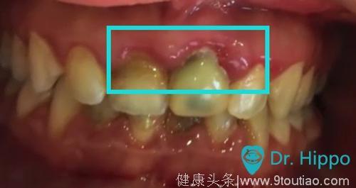 如何预防口腔慢性病——牙周病？