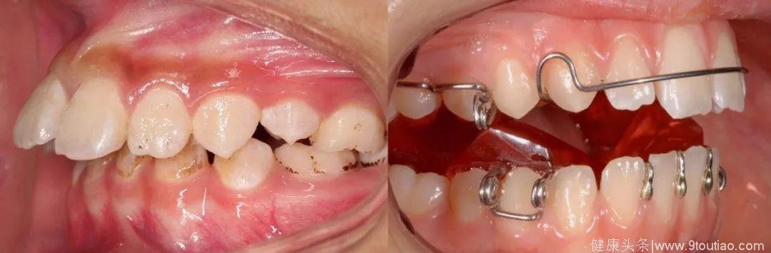 西苑口腔｜儿童牙齿不齐何时开始正畸治疗？