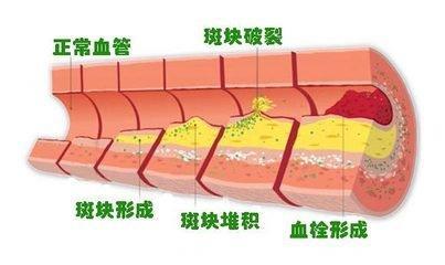 得了 冠心病，这两项治疗就要坚持！