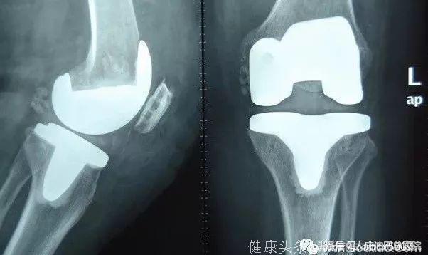 骨科副主任医师和你谈关节健康：膝关节疼痛不一定就是风湿……