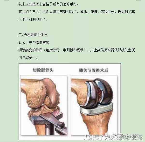 骨科副主任医师和你谈关节健康：膝关节疼痛不一定就是风湿……