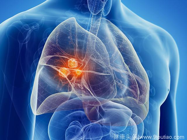 肺癌警告：出现这7个症状时，你正处于危险