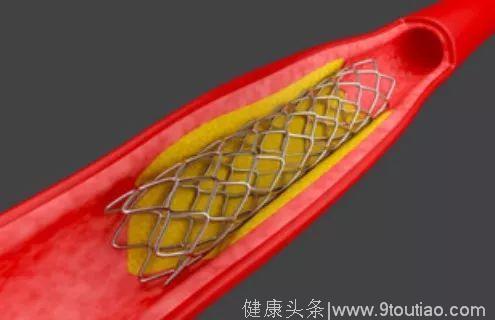选支架还是搭桥？一张表格就说清楚了！「冠心病系列之40」