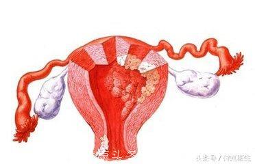 水样白带查出“子宫内膜癌”！这几种白带异常需要警惕妇科癌症！