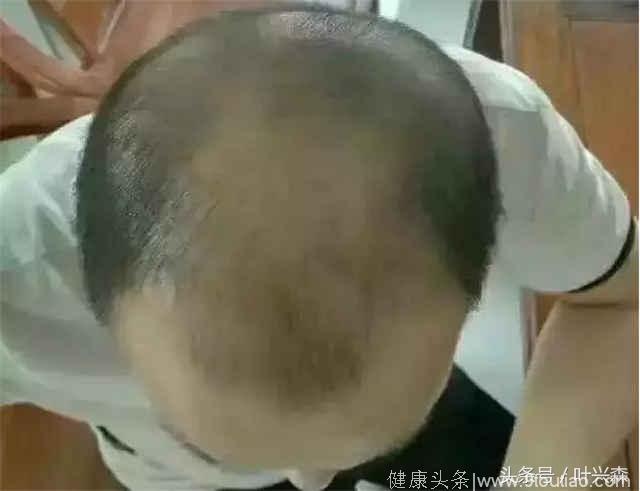 调理脱发、掉发方案，让秃顶人士也能长出浓密头发！