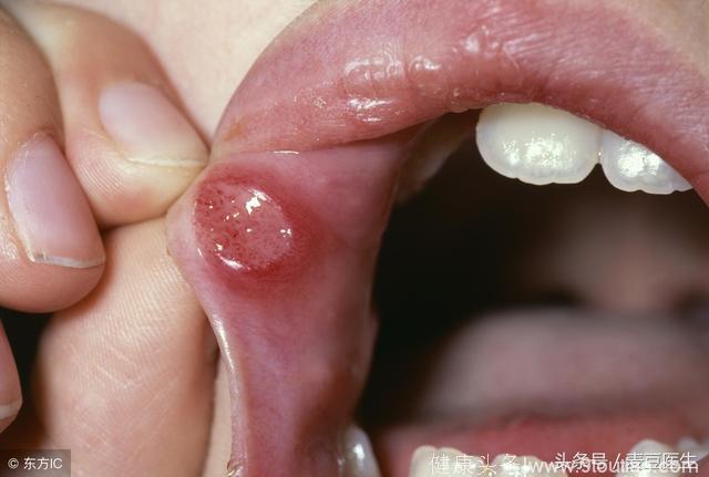 口腔溃疡老不好，有可能是口腔癌吗？听口腔科专家怎么说