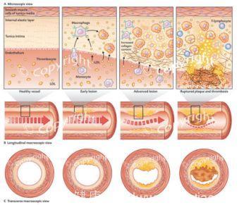 《Nature》：突破！单克隆抗体或有望治疗冠心病！