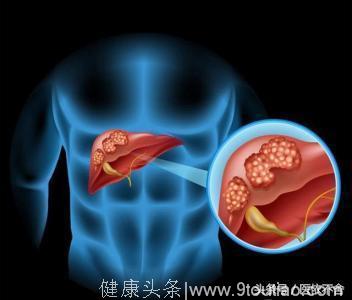 肝硬化患者的食物选择及8点注意