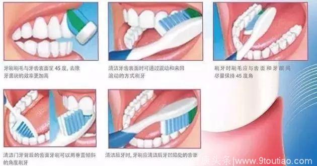 “巴氏刷牙法”可有效去除牙龈附近及龈沟内菌斑