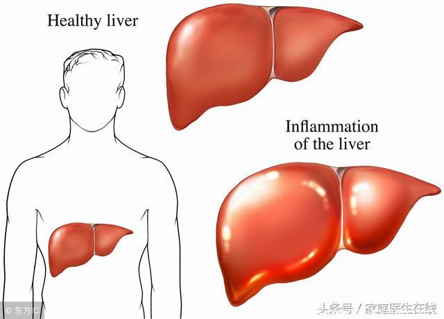 医生：5年的抗病毒治疗后，74%肝硬化患者可以发生逆转