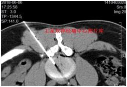 椎间盘突出见怪不怪，除了手术外，还可以试试这个治疗方法