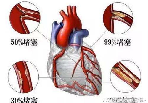 得了高血压，需要吃阿司匹林保护心脏吗？