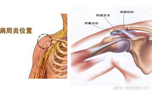 肩周炎患者越来越多，严重者试试这几个治疗方法