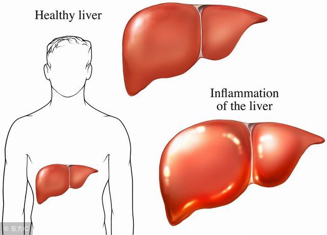 肝癌“癌中之王”而它是公认的肝病克星 三大穴位常按摩最养肝
