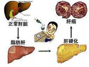 走出脂肪肝误区，坚持5件事，谨防脂肪肝变肝癌