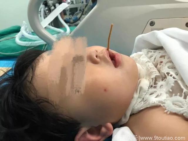 13厘米竹签扎进两岁女童口腔 11个学科团队联手救命