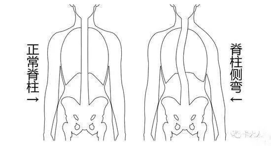 駝背,高低肩,扁平足,八字腳,脊柱側彎,專家教你運動糾正方法