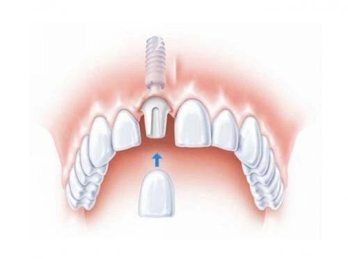 创想三维3D打印技术颠覆牙科义齿制造 让牙模生产效率提升十倍