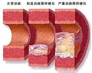 这些都是身体发出的冠心病“信号”！请马上去医院