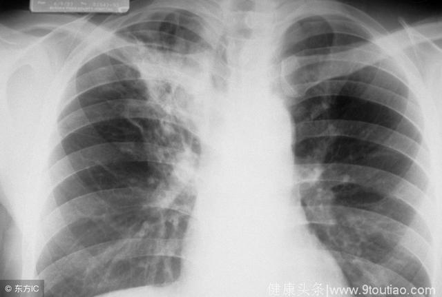 广州女子将咳嗽当感冒，结果是肺结核！出现这些症状别大意