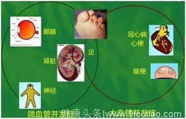 代谢综合征·糖尿病·大动脉病变