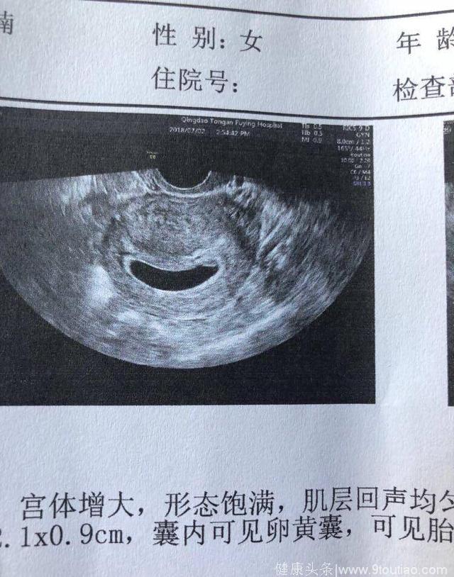 经历一次胎停育后再次怀孕 49天见胎心胎芽！