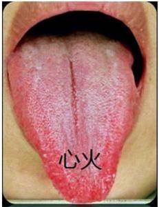 糖尿病病人好帮手，看舌头辨别体质选择中药辅助治疗糖尿病