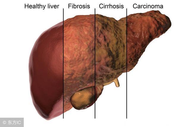 出现4种变化，警惕脂肪肝病变，用1植物根煎水喝，肝功能慢慢恢复