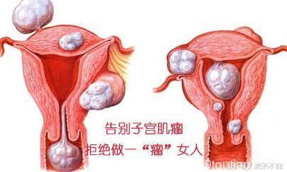 最常见的妇科疾病——子宫肌瘤只能开刀拿掉吗？