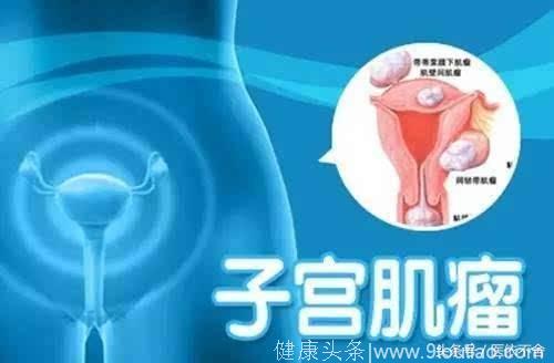 最常见的妇科疾病——子宫肌瘤只能开刀拿掉吗？