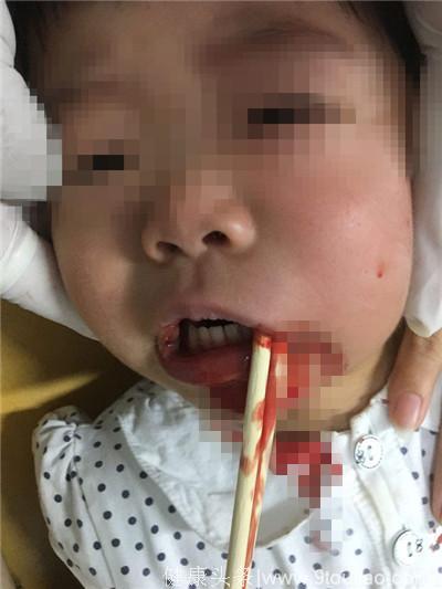 「惊险」15厘米筷子插入1岁孩子口腔，省立三院成功救治