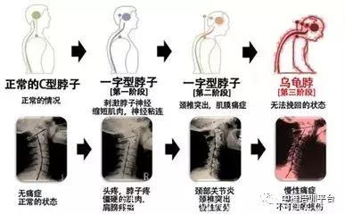 颈椎酸疼难忍，一个小动作就能治，还能降血压！