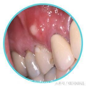 口腔护理系列：牙周脓肿，牙龈肿痛怎么办？