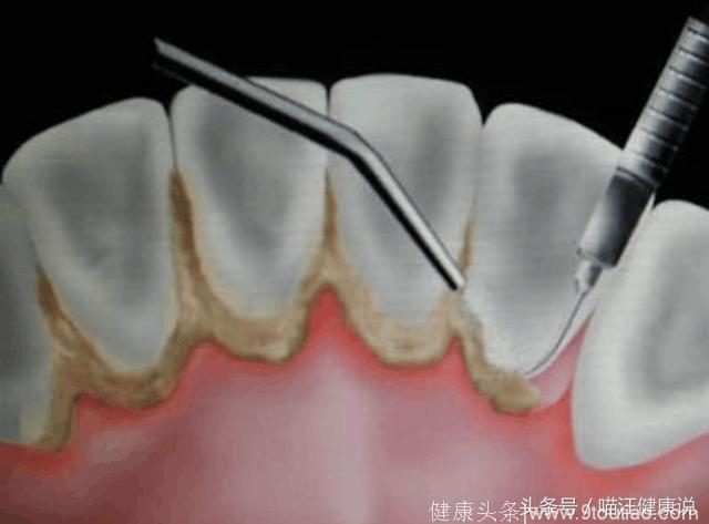 口腔护理系列：牙周脓肿，牙龈肿痛怎么办？